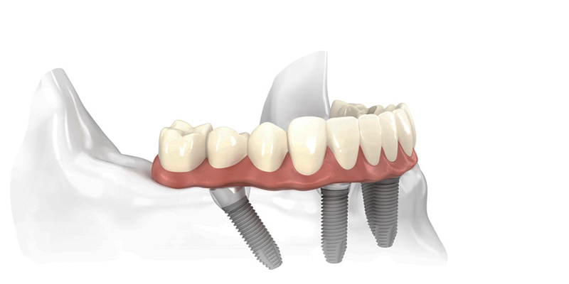 Fixed Bridge Anchored to Dental Implants